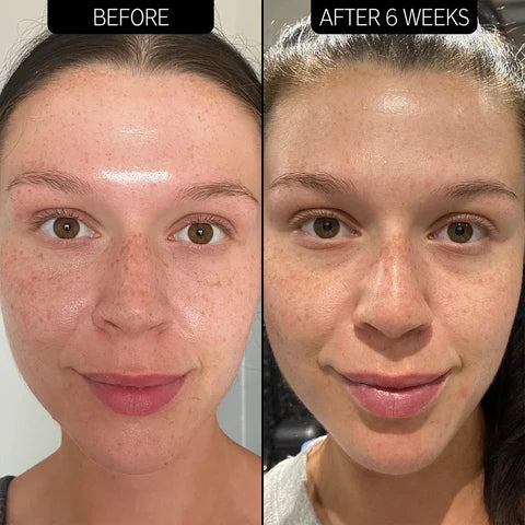 Niacinamida 10% + Zinc 1%